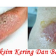 Illustration for article titled obat gatal kulit eksim keringem/em